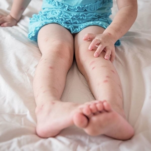 Child's legs with bed bug bites
